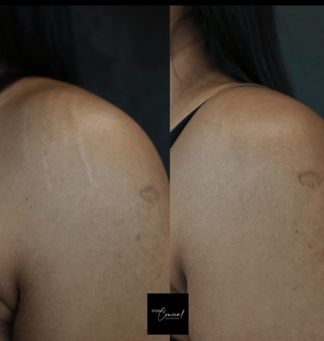 shoulder surgery scar tattoo