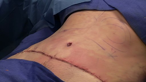 tummy tuck scar