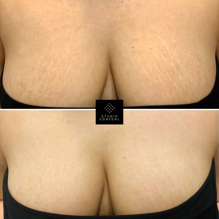 white stretch mark concealed
