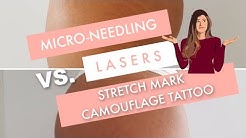 microneedling vs lasers vs stretch mark camouflage tattoo