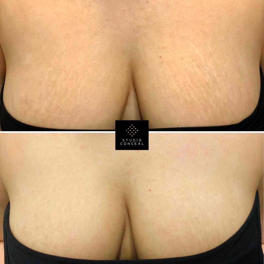 brazilian stretch mark camouflage on breasts