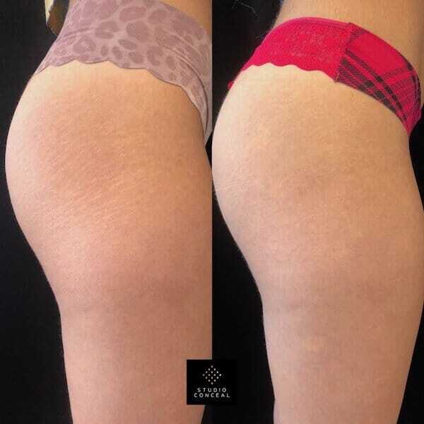 before and after stretch mark tattoo