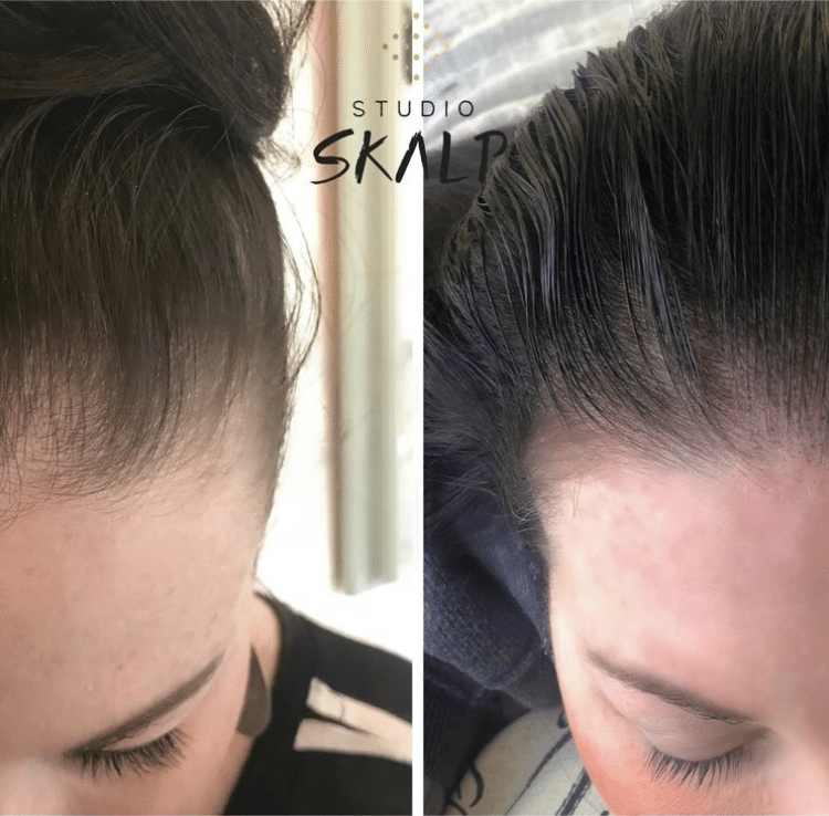 scalp micropigmentation with hair before and after