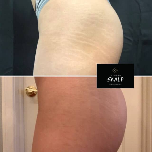 before and after stretch mark conceal