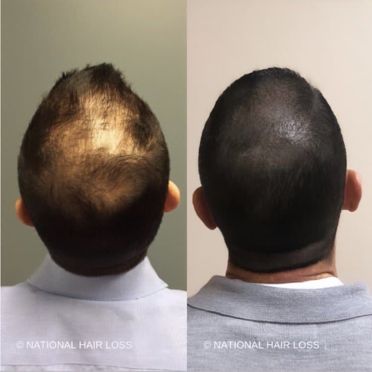scalp micropigmentation in arizona before after