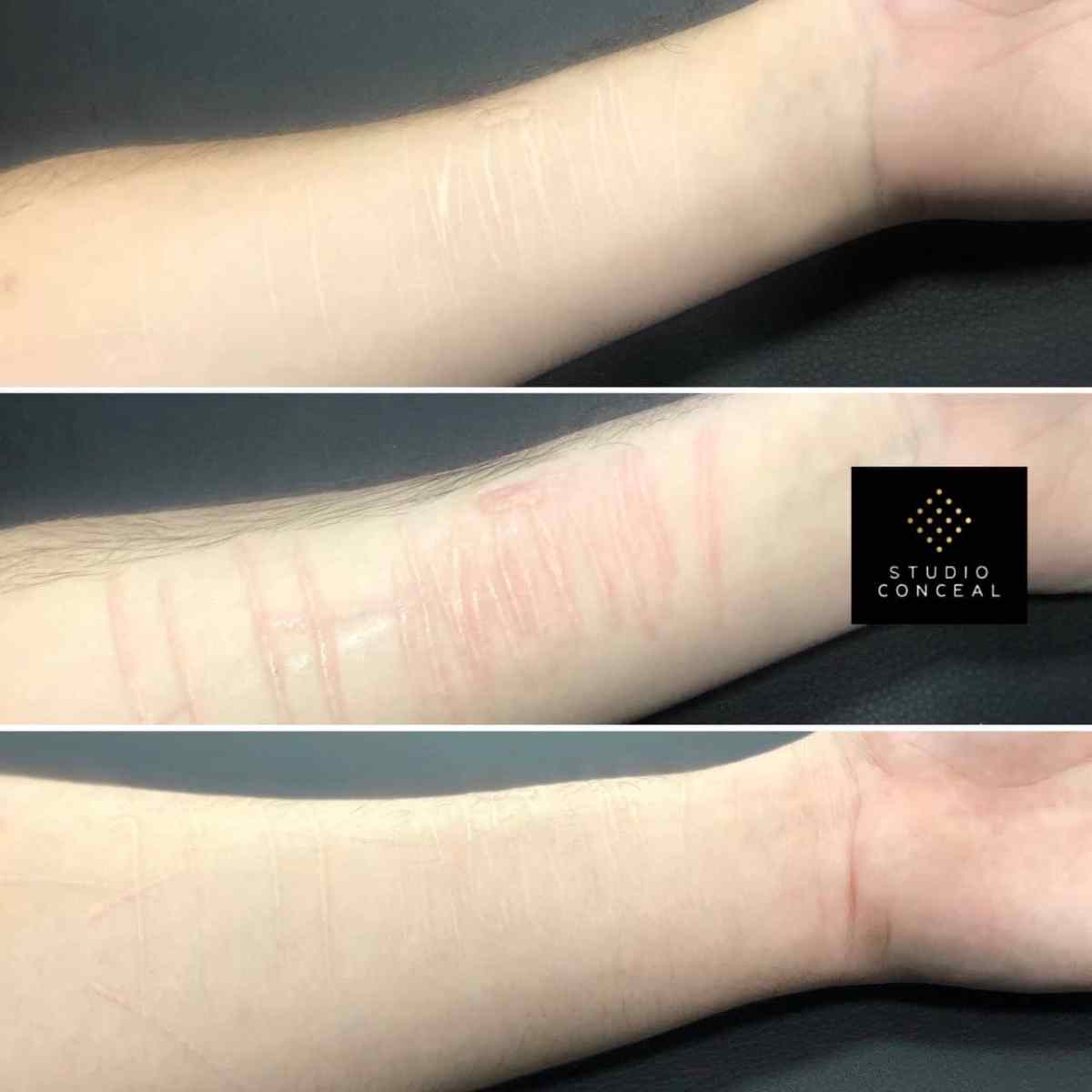 Best Scar Camouflage with medical tattooing in UK by registered nurse