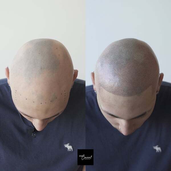 hair tattoo before and after