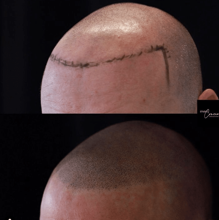 Hair tattoo or scalp micropigmentation