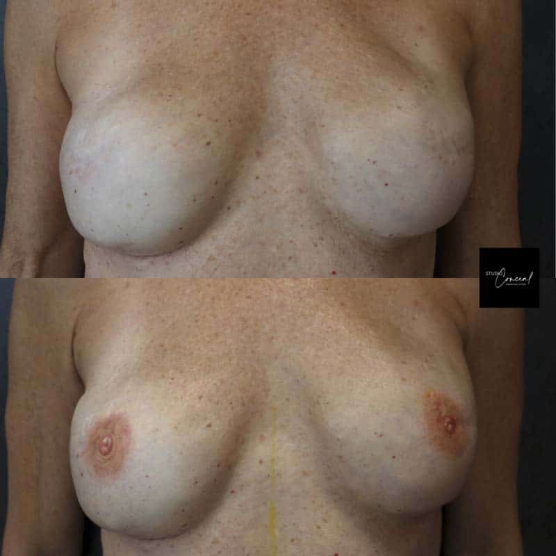 nipple tattoo post mastectomy
