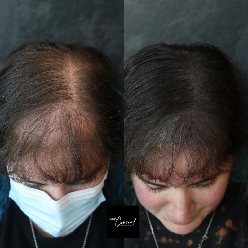Scalp Micropigmentation Before and After