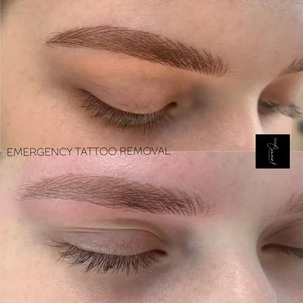 Laser eyebrow tattoo removal before and after