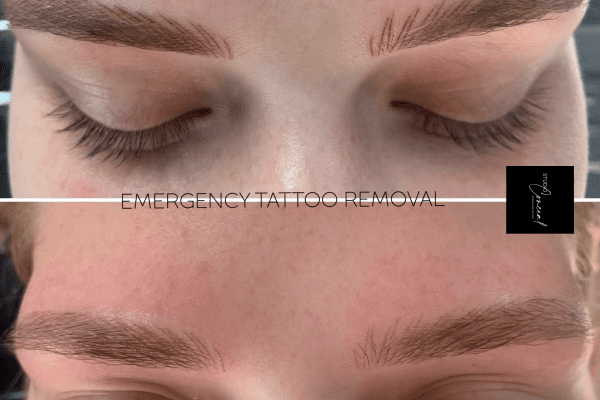 Eyebrow Tattoo Removal | Before & Aftercare + Side Effects