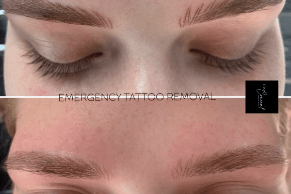 Looking for eyebrow tattoo removal Heres what you need to know