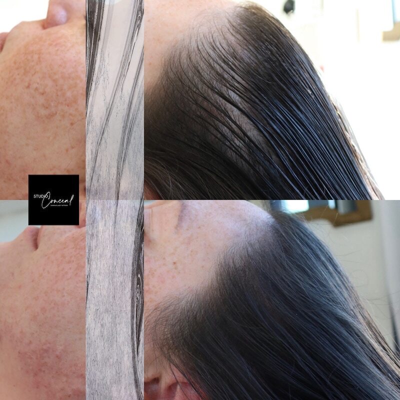 Scalp micropigmentation for long hair