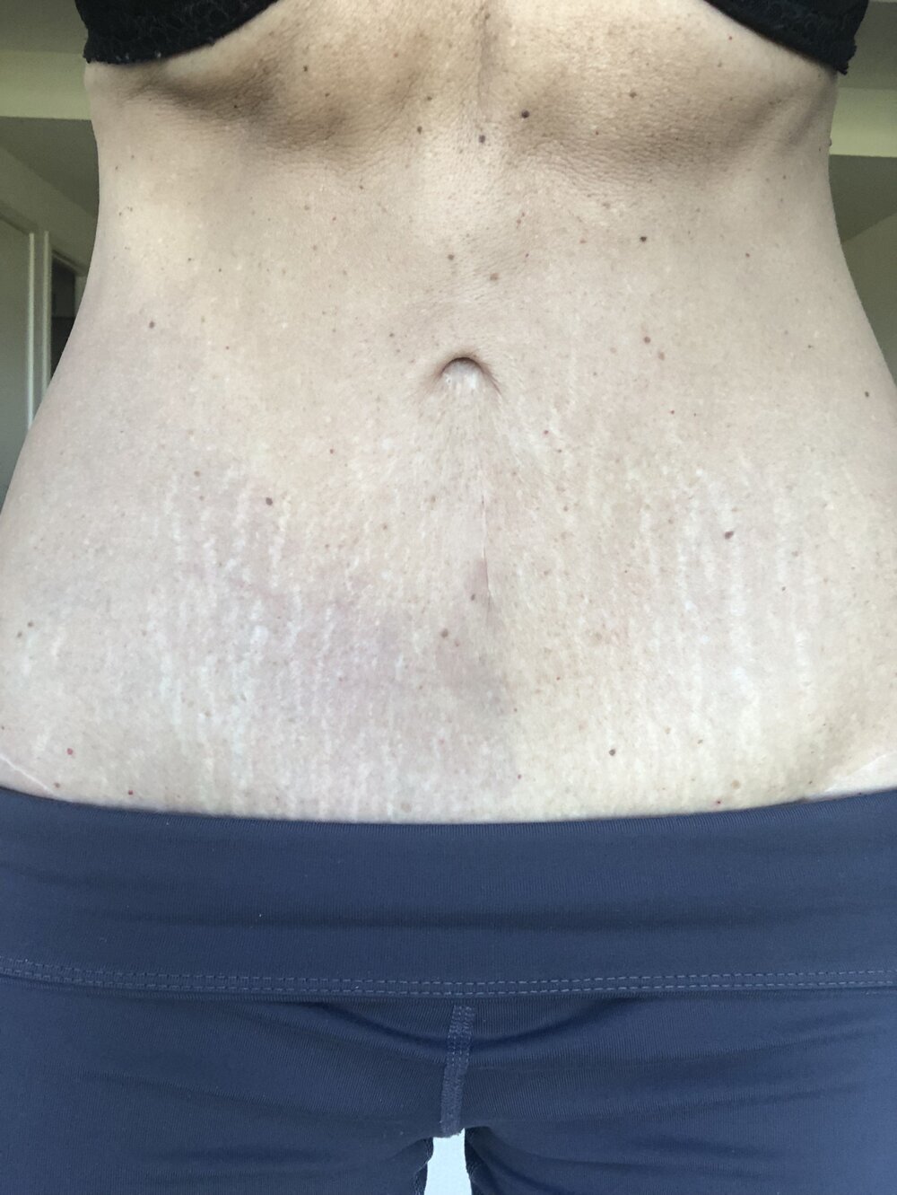 Stretch marks from pregnancy